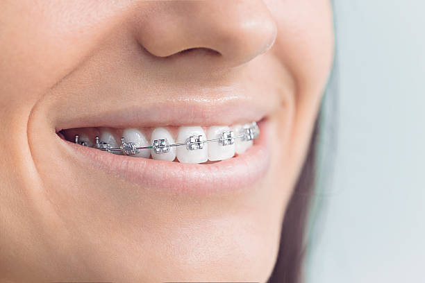 Best Traditional Braces  in Monroe, UT